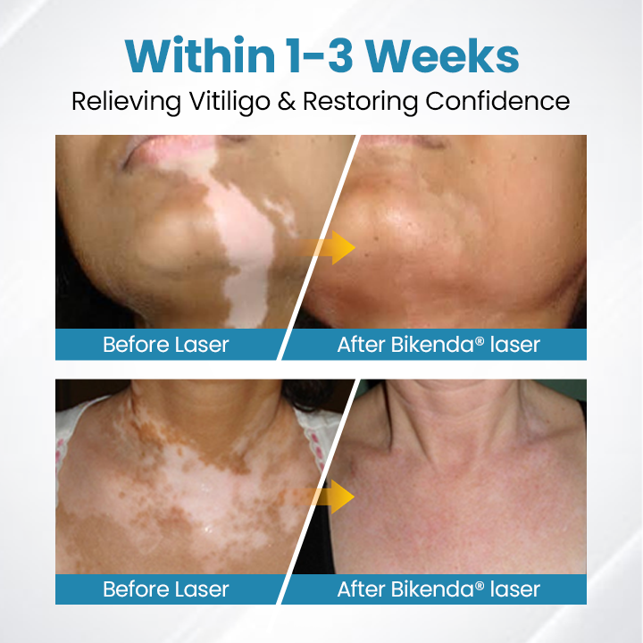 Bikenda® DermaBeam Vitiligo Therapy Device ✅3-5 Second Vitiligo Treatment, Visible Results in Just 2 Weeks