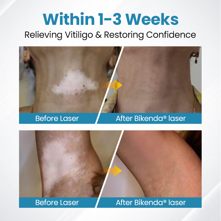 Bikenda® DermaBeam Vitiligo Therapy Device ✅3-5 Second Vitiligo Treatment, Visible Results in Just 2 Weeks