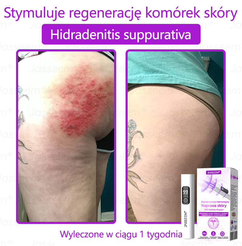 💎𝐉𝐚𝐬𝐬𝐞𝐞𝐦® Zaawansowany nieinwazyjny laser CO₂ do naprawy skóry 🎉 (Delikatnie usuwa brodawki, znamiona, plamy starcze i narośla skórne – bez bólu, bez zamieszania!)