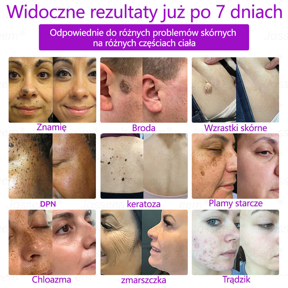 💎𝐉𝐚𝐬𝐬𝐞𝐞𝐦® Zaawansowany nieinwazyjny laser CO₂ do naprawy skóry 🎉 (Delikatnie usuwa brodawki, znamiona, plamy starcze i narośla skórne – bez bólu, bez zamieszania!)