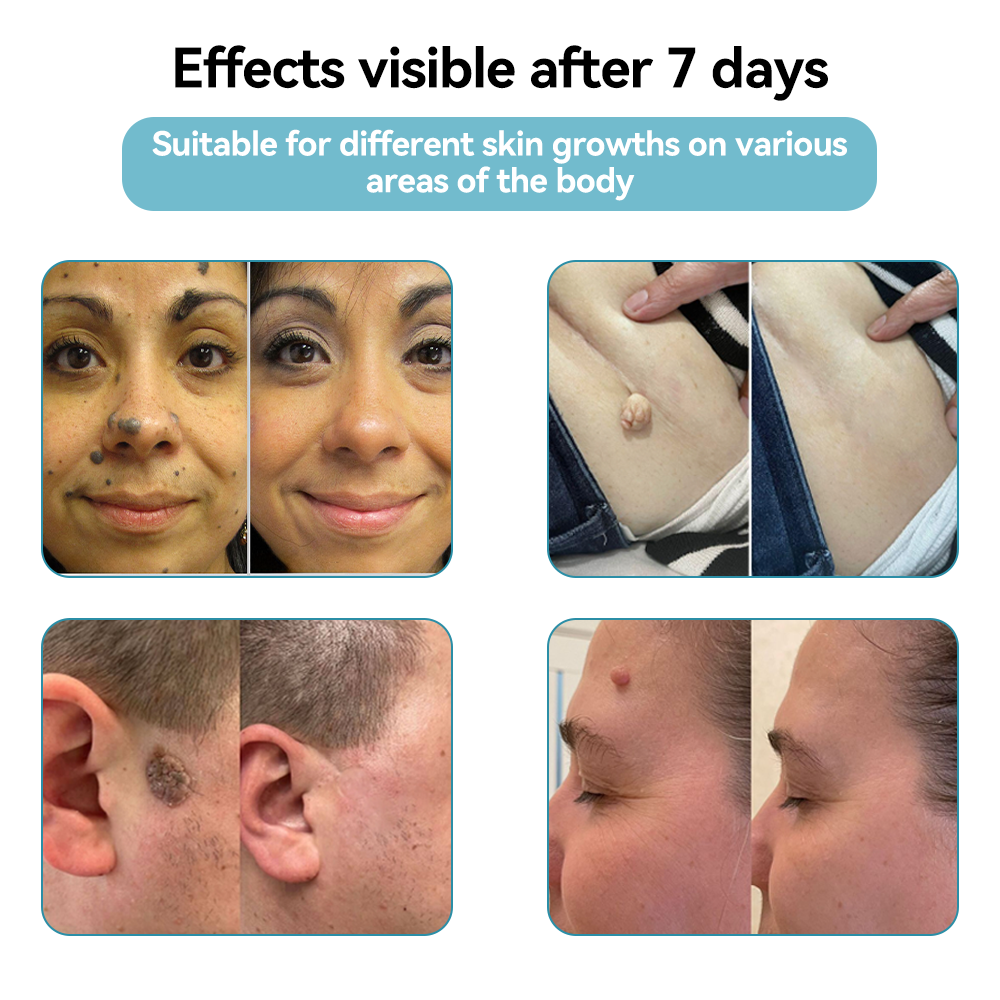 ๐๐๐ฌ๐ฌ๐๐๐ฆยฎ ๐ณMedical-Grade Laser Pen (Powered by COโ laser technology โ effectively removes moles, warts, skin tags, pigmentation spots, and other skin imperfections)