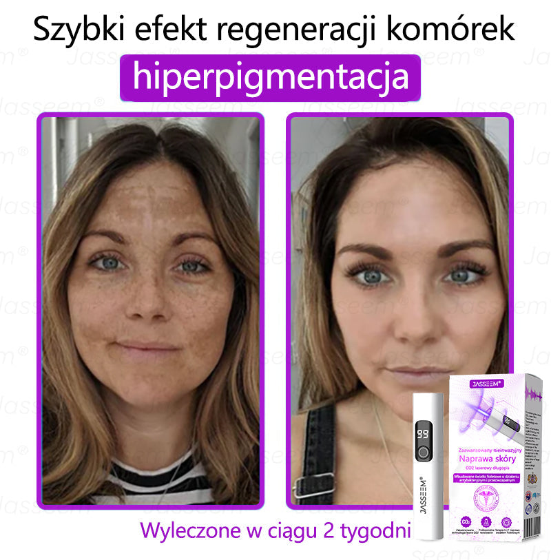 💎𝐉𝐚𝐬𝐬𝐞𝐞𝐦® Zaawansowany nieinwazyjny laser CO₂ do naprawy skóry 🎉 (Delikatnie usuwa brodawki, znamiona, plamy starcze i narośla skórne – bez bólu, bez zamieszania!)
