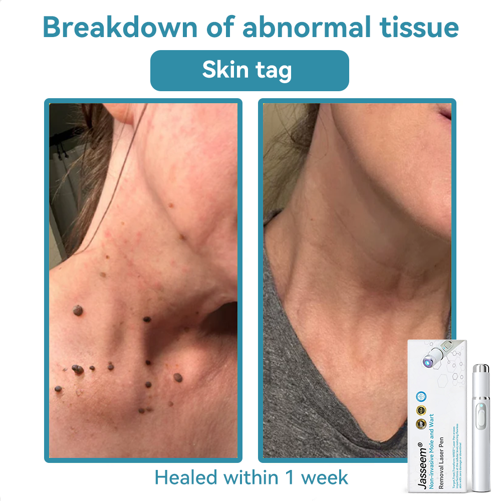 ๐๐๐ฌ๐ฌ๐๐๐ฆยฎ ๐ณMedical-Grade Laser Pen (Powered by COโ laser technology โ effectively removes moles, warts, skin tags, pigmentation spots, and other skin imperfections)