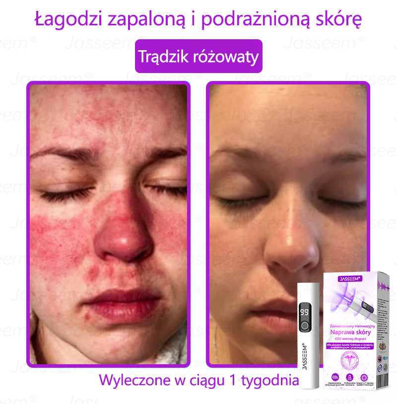 💎𝐉𝐚𝐬𝐬𝐞𝐞𝐦® Zaawansowany nieinwazyjny laser CO₂ do naprawy skóry 🎉 (Delikatnie usuwa brodawki, znamiona, plamy starcze i narośla skórne – bez bólu, bez zamieszania!)