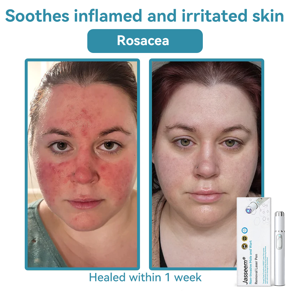 ๐๐๐ฌ๐ฌ๐๐๐ฆยฎ ๐ณMedical-Grade Laser Pen (Powered by COโ laser technology โ effectively removes moles, warts, skin tags, pigmentation spots, and other skin imperfections)