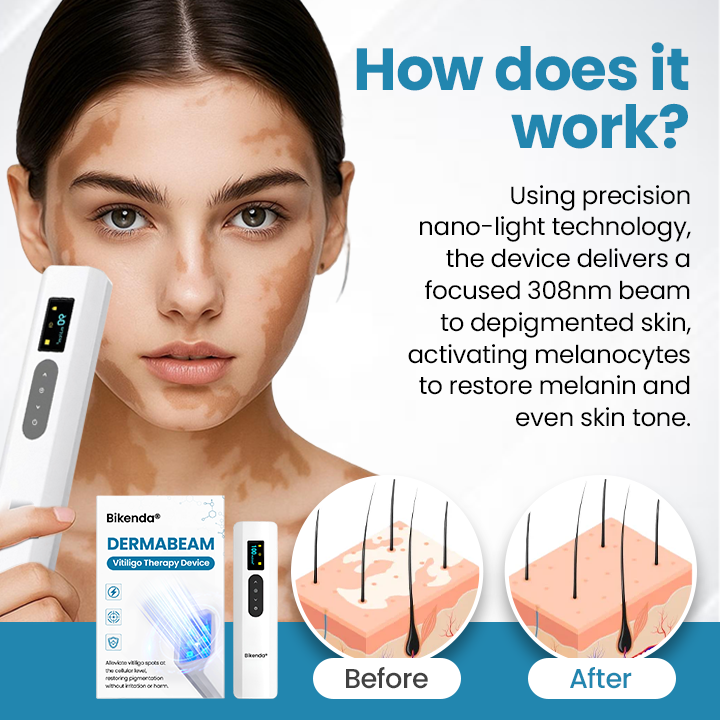 Bikenda® DermaBeam Vitiligo Therapy Device ✅3-5 Second Vitiligo Treatment, Visible Results in Just 2 Weeks