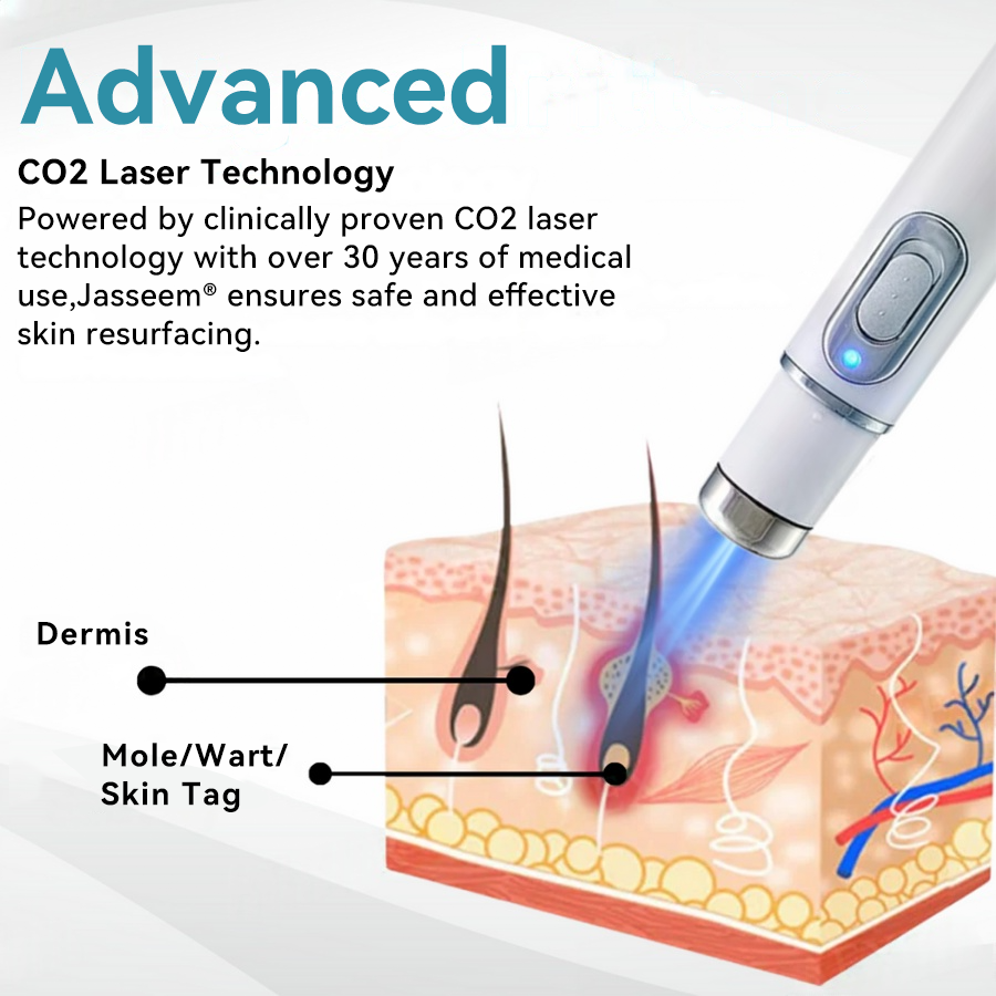 ๐๐๐ฌ๐ฌ๐๐๐ฆยฎ ๐ณMedical-Grade Laser Pen (Powered by COโ laser technology โ effectively removes moles, warts, skin tags, pigmentation spots, and other skin imperfections)