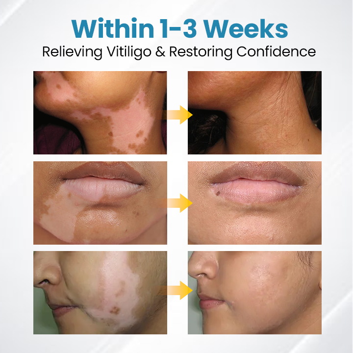 Bikenda® DermaBeam Vitiligo Therapy Device ✅3-5 Second Vitiligo Treatment, Visible Results in Just 2 Weeks