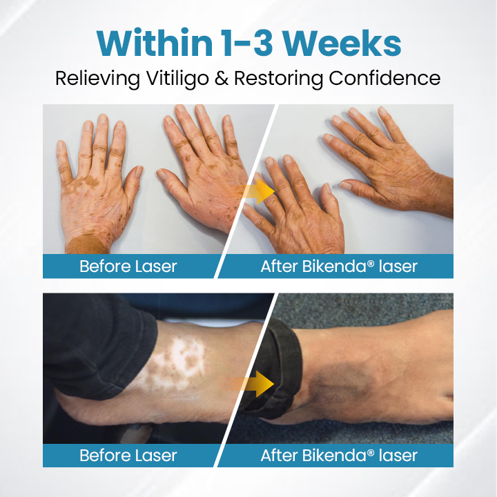 Bikenda® DermaBeam Vitiligo Therapy Device ✅3-5 Second Vitiligo Treatment, Visible Results in Just 2 Weeks