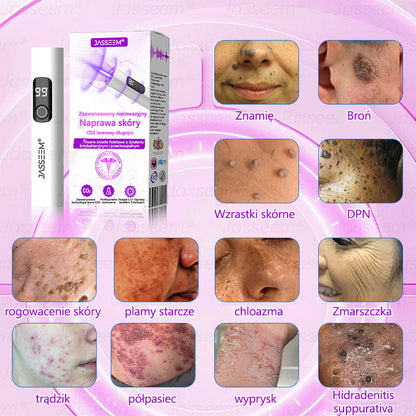 💎𝐉𝐚𝐬𝐬𝐞𝐞𝐦® Zaawansowany nieinwazyjny laser CO₂ do naprawy skóry 🎉 (Delikatnie usuwa brodawki, znamiona, plamy starcze i narośla skórne – bez bólu, bez zamieszania!)