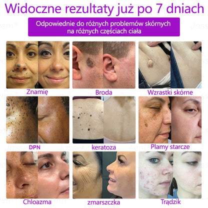 💎𝐉𝐚𝐬𝐬𝐞𝐞𝐦® Zaawansowany nieinwazyjny laser CO₂ do naprawy skóry 🎉 (Delikatnie usuwa brodawki, znamiona, plamy starcze i narośla skórne – bez bólu, bez zamieszania!)