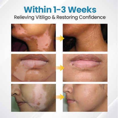 Bikenda® DermaBeam Vitiligo Therapy Device ✅3-5 Second Vitiligo Treatment, Visible Results in Just 2 Weeks